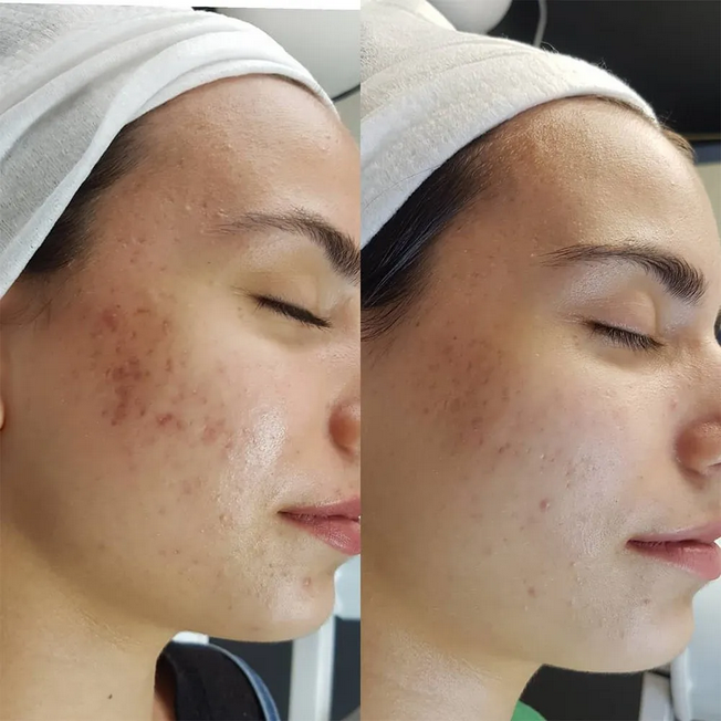 Derma Stamp - Titanium