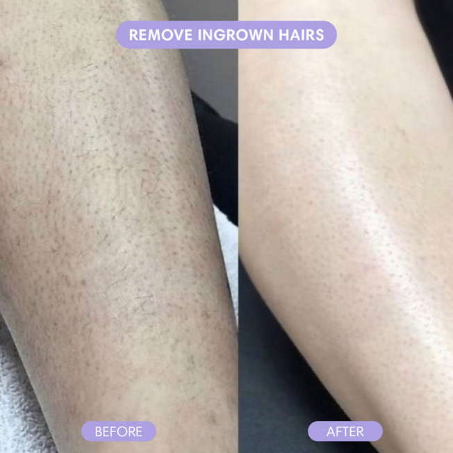 Painless Crystal Hair Remover